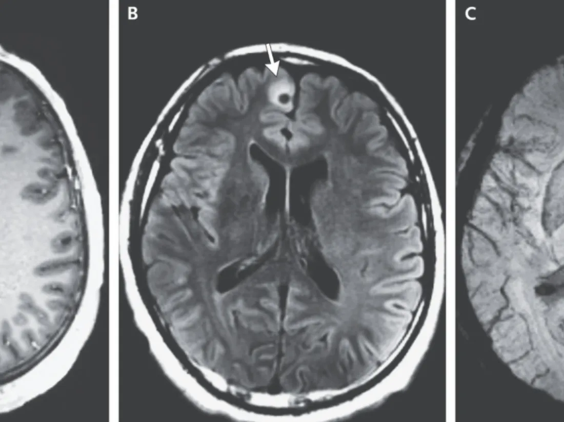 Le scanner de l'homme avec un ténia dans le cerveau